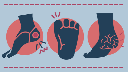 Foot Health Tips for Spring